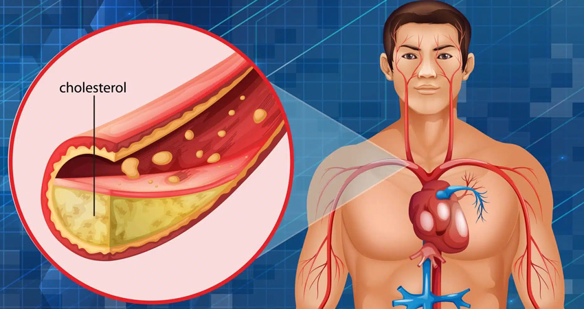 Cholesterol & Lipid Disorders