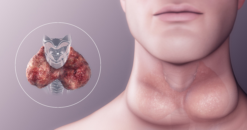 Hypothyroidism