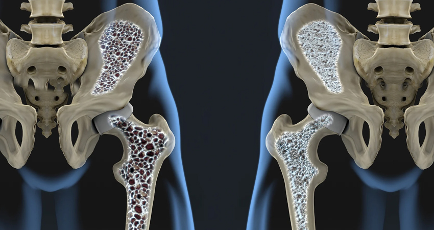 Osteoporosis