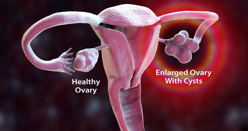 PCOS