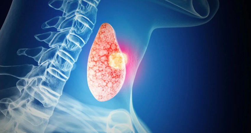 Thyroid Cancer