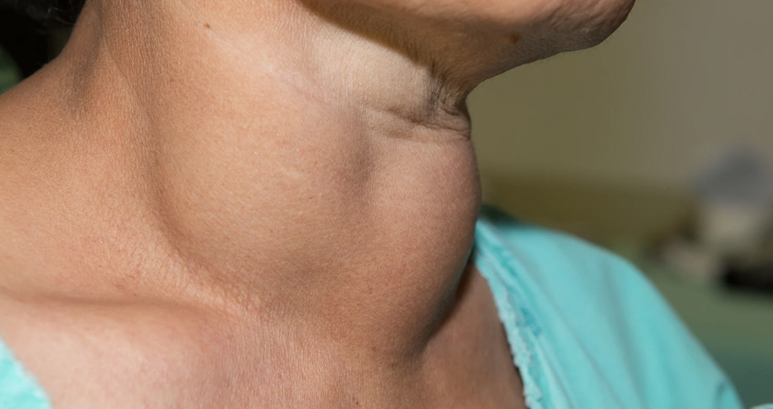 Thyroid Nodules & Goitre